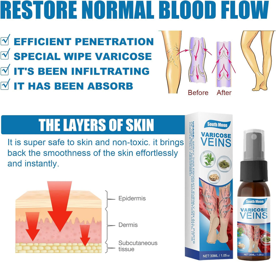 VARICOSE VEINS
