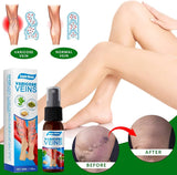 VARICOSE VEINS